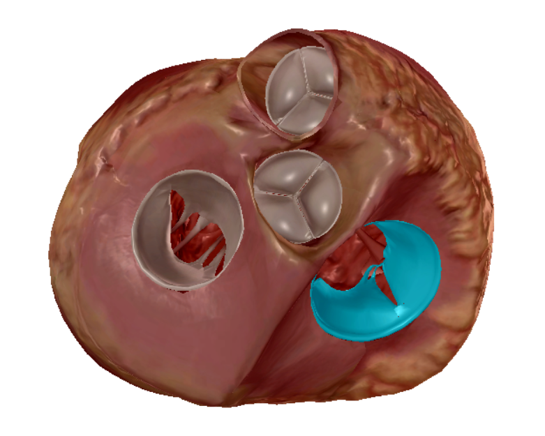 <p>right atrium to right ventricle</p>