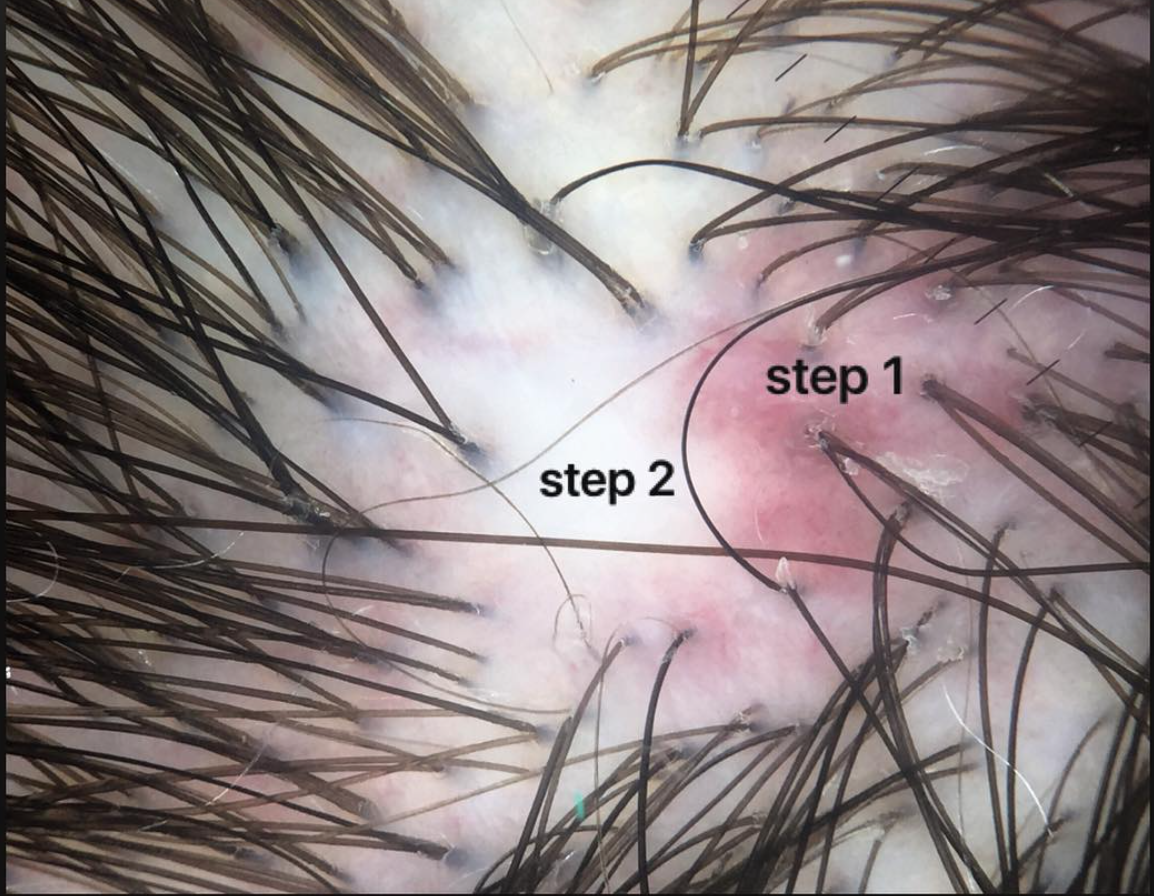<p>Hair loss caused by the replacement of hair follicles with scar tissue.</p>
