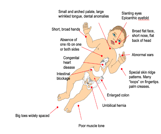 <p><span style="font-family: Arial, sans-serif;">•</span><span style="font-family: "Times New Roman"; line-height: normal; font-size: 7pt;"> </span><span>This is the most common form of aneuploidy in human newborns that remain viable at birth.</span></p><p class="MsoNormal"><span style="font-family: Arial, sans-serif;">•</span><span style="font-family: "Times New Roman"; line-height: normal; font-size: 7pt;"> </span><span>Incidence rate of <strong>1</strong> in <strong>800</strong> births in women giving birth at 30 to 31 years of age. Relatively frequent in children of older mothers.</span></p><p class="MsoNormal">Causes</p><p class="MsoNormal"><span style="font-family: Arial, sans-serif;">•</span><span style="font-family: "Times New Roman"; line-height: normal; font-size: 7pt;"> </span><span>There are <strong>three causes</strong> of Down syndrome, each producing a <strong>different severity</strong> of the syndrome.</span></p><p class="MsoNormal"><span style="font-family: Arial, sans-serif;">•</span><span style="font-family: "Times New Roman"; line-height: normal; font-size: 7pt;"> </span><span><strong>95%</strong> of all cases result from <strong>non-disjunction</strong> of chromosome<strong> 21</strong> during meiosis (see the karyotype right).</span></p><p class="MsoNormal"><span style="font-family: Arial, sans-serif;">•</span><span style="font-family: "Times New Roman"; line-height: normal; font-size: 7pt;"> </span><span><strong>3-4%</strong> result from <strong>translocation</strong> of chromosome <strong>21</strong> (usually on to chromosome <strong>14</strong>).</span></p><p class="MsoNormal"><span style="font-family: Arial, sans-serif;">•</span><span style="font-family: "Times New Roman"; line-height: normal; font-size: 7pt;"> </span><span><strong>1-2%</strong> arise from a <strong>failure</strong> during <strong>mitosis</strong> (<strong>non</strong>-<strong>disjunction</strong> of chromosome <strong>21</strong>) in a cell of a very early embryo. The resulting individual is a ‘<strong>mosaic</strong>’ of normal and Down syndrome cells.</span></p><p class="MsoNormal"></p>