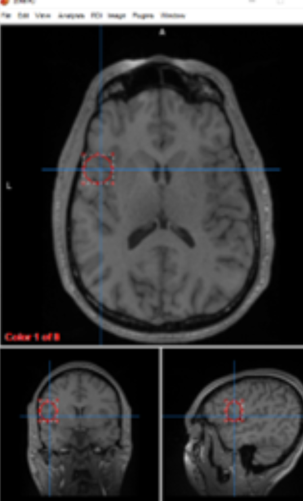 <p>anterior insular cortex</p>