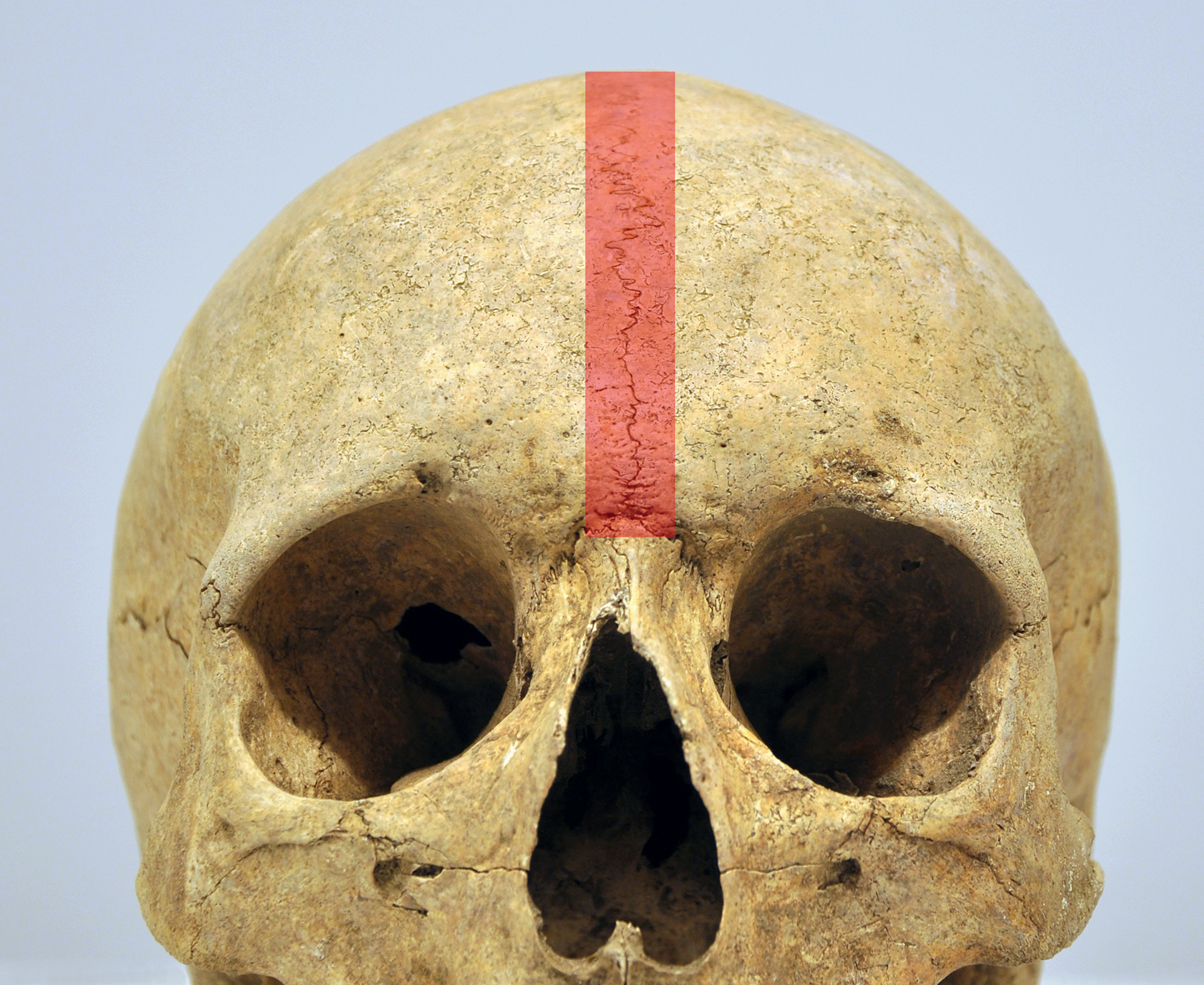 <p>Suture between the two halves of the frontal bone that fuses within the first few years of life, at which point the frontal bone is one solid piece.</p>