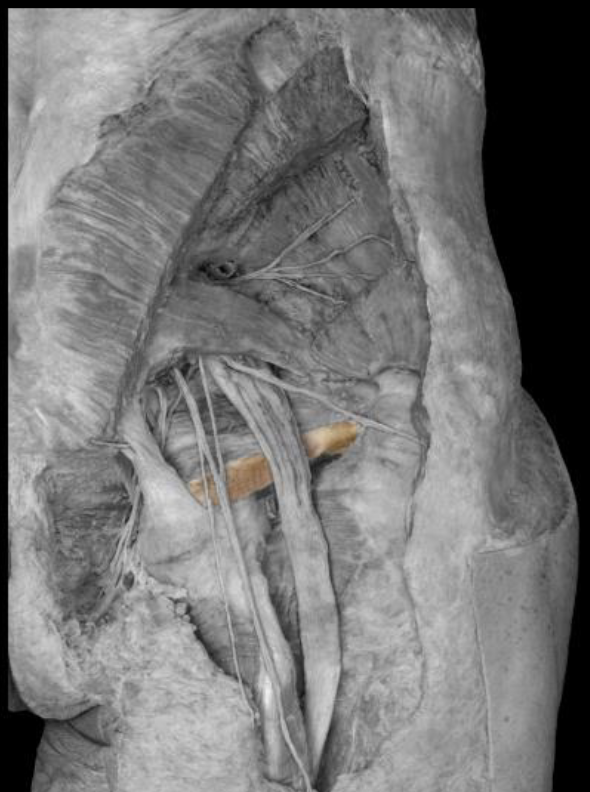 <p>origin of gemellus inferior</p>