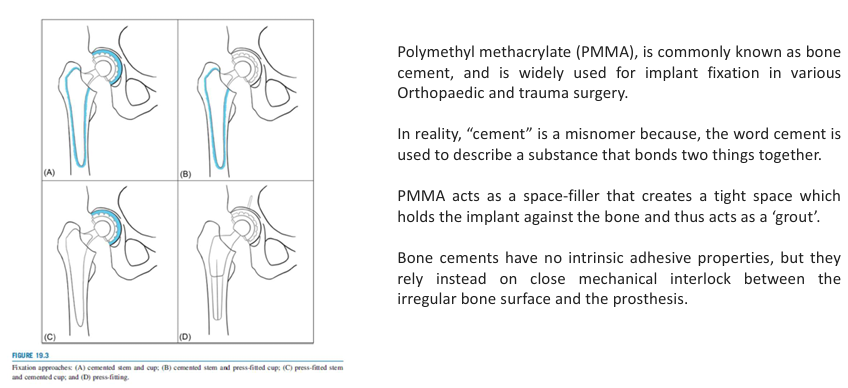 <p>Polymethyl methacrylate (PMMA), is commonly known as bone cement, and is widely used for implant fixation in various Orthopaedic and trauma surgery, not really cement just substance that bonds two things together, acts as a space filler kinda like grout, not adhesive instead relies on close mechanical interlock between the irregular bone surface and the prosthesis</p>