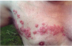 <p>Atteinte virale par Herpes Zoster persistant (après la varicelle) au niveau du ganglion rachidien : apparition de vésicules herpétiques dans le dermatome correspondant.</p>