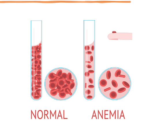 <p>What is anemia?<br></p>