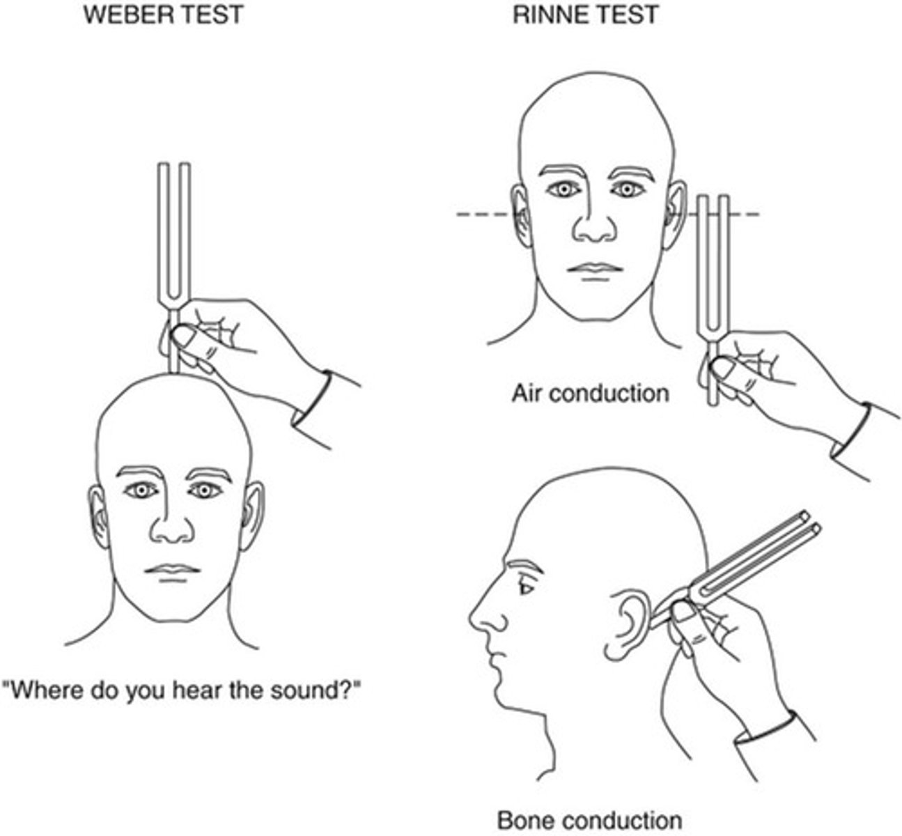 <p>Use of tuning fork to distinguish between conductive and sensorineural hearing losses</p>