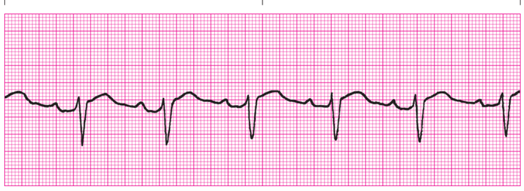 <ol><li><p>Regularity?</p></li><li><p>Rate</p></li><li><p>PWaves</p></li><li><p>PRI</p></li><li><p>QRS</p></li><li><p>Interpretation </p></li></ol><p></p>