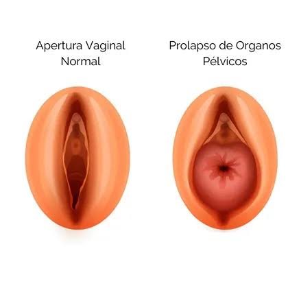 <p>Descenso o desplazamiento de un órgano interno desde su posición habitual debido al debilitamiento de los músculos y tejidos que lo sostienen.</p>