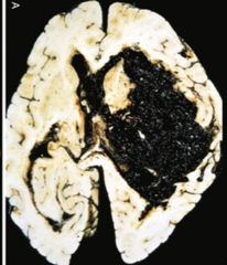 <p>What are Charcot-Bouchard aneurysms?</p>