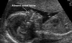 <p>Nasal bone is either absent or underdeveloped, per visualization on 1st or 2nd trimester ultrasound. Is a common finding in certain ethnic groups, but is also a soft marker for aneuploidy especially T21 and a part of Warfarin embyropathy</p>