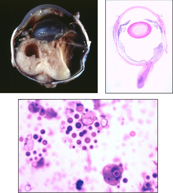 <ul><li><p><strong>pyogranulomatous chorioretinitis</strong></p></li><li><p>also: nasal cavity, cutaneous involvement, brain</p></li><li><p>thin-walled yeast, narrow-based budding, thick capsule</p></li></ul><p></p>