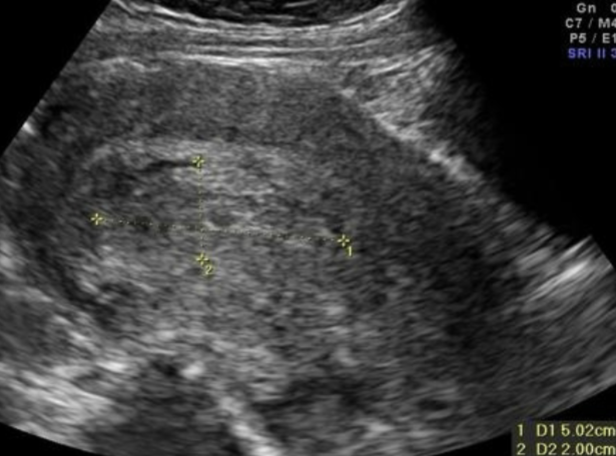 <ul><li><p>Hyperechoic mass in the endometrial canal</p><ul><li><p>remnants of placental tissue (called a placental polyp), are b/c of incomplete placental expulsion from the uterus</p></li></ul></li><li><p>A heterogenous mass may contain necrotic tissue, clot, or infection</p></li><li><p>may appear similar to endometritis</p></li></ul><p></p>