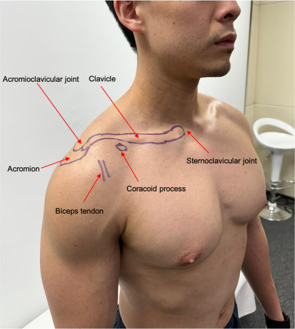 <p><strong>How to Palpate:</strong></p><ul><li><p>Broad, flat bone superior/lateral shoulder.</p></li></ul><p></p><p>Confirm: Follow anteriorly to the acromial angle; follow posteriorly into scapular spine.</p>