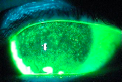 <p>Burning foreign body sensation, conjunctival injection, and photophobia.</p><p>Decreased tear production.</p><p> • Medications</p><p> • Sarcoidosis</p><p> • Sjogren's syndrome</p>