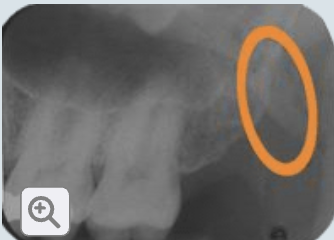 <p>What is the hamulus (hamular process)?</p>