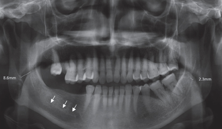 <p><strong>Mandibular canal</strong></p>