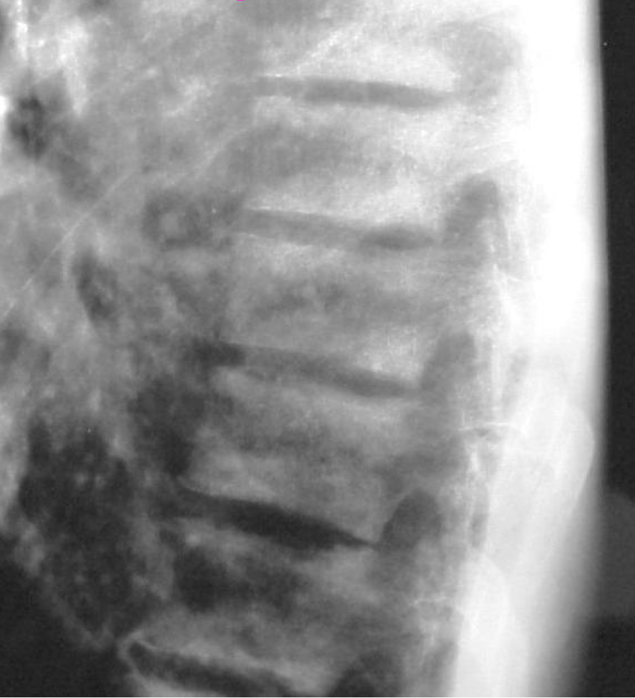 <p>What is the most likely Dx</p>