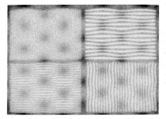 <p>What is the cause of the depicted abnormality?</p>