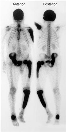 <p>intense uptake involving 1+ bones; usually diffuse through entire affected bone. common sites: pelvis, spine, skull, long bones</p>