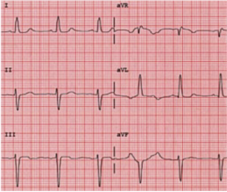 <p>QRS Classification for this tracing</p>