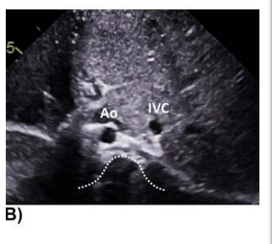 <p>Situs Inversus • </p><p>Aorta on the right •</p><p>IVC anterior and to the left of the aorta • </p><p>Liver on the left • RA is on the left • </p><p>Left sided trilobed lung • </p><p>Right sided bi lobed lung • </p><p>Right sided stomach •</p><p> Right sided spleen</p>