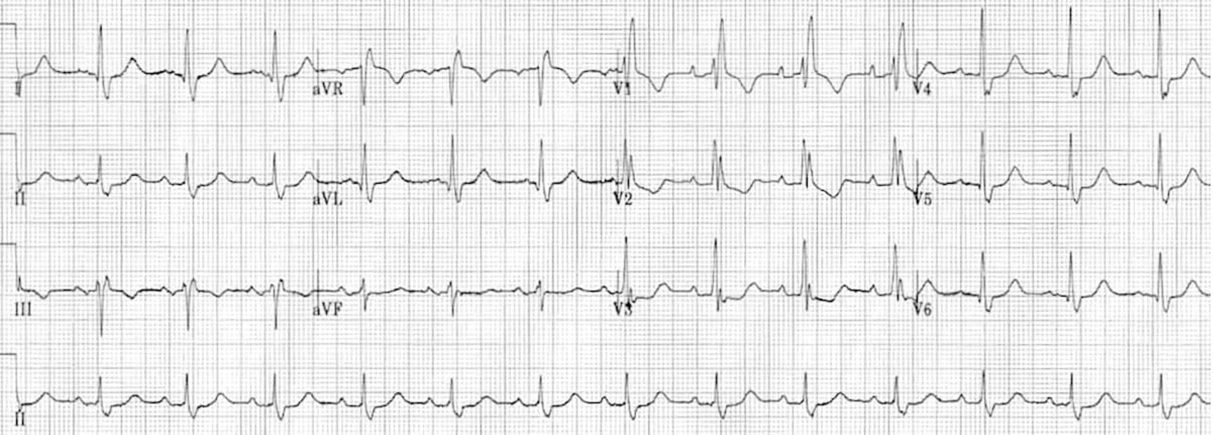 <p>What rhythm/abnormality is seen below?</p>