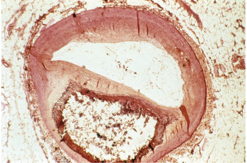 <ol><li><p>Sickle Cell Anemia</p></li><li><p>Atherosclerosis</p></li><li><p>Adenocarcinoma of Kidney</p></li><li><p>Osteogenic Sarcoma of Bone</p></li><li><p>Tattoo in Human Skin</p></li><li><p>Neurilemmoma</p></li><li><p>Anthracosis of the Lung</p></li><li><p>Basal Cell Carcinoma</p></li><li><p>Lung</p></li><li><p>Skeletal</p></li><li><p>Kidney</p></li><li><p>Neuron</p></li><li><p>Skin</p></li><li><p>Blood</p></li><li><p>Bone</p></li><li><p>Aorta</p></li></ol><p></p>