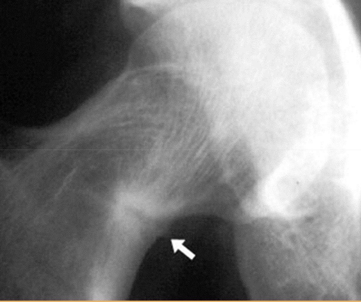 <p>What finding is seen in this image of a pt with Osteomalacia </p>
