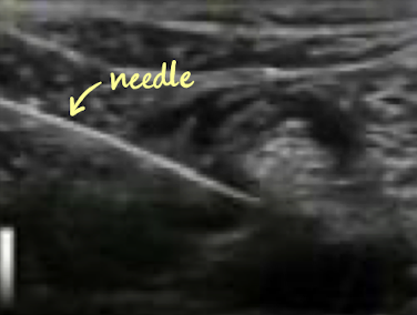 <ul><li><p>visualization of needle is most important part of procedure</p></li><li><p>if needle is not visualized, transducer should be moved, not the needle</p></li><li><p>needle must be in the center of the transducer</p></li><li><p>TIP: the more perpendicular the sound beam is to the needle, the more sound will return → better reflection from the needle</p></li><li><p>providers have 2 techniques to introduce needles and devices into patients</p><ul><li><p>free-hand</p></li><li><p>mechanically guided technique </p></li></ul></li></ul><p></p>