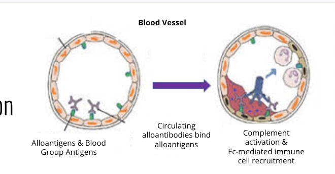 <ol><li><p>occurs when blood does not match the host body</p><ol><li><p>allontigens and blood group antigens cause mismatch = rejection by natural antibodies (MHC)</p></li><li><p>antibodies bind to the endotheilum and triegger complent, clotting cascade and immune cell recruitment</p><ol><li><p>causes plaque build up and artherosculrosis in the blood vessle</p></li></ol></li><li><p>mostly problematic folliwng other blood trasfusions, transplants, or xenografs</p></li></ol></li></ol><p></p>