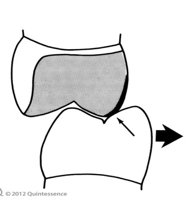 <p>A&nbsp;premature contact (small arrow) on the palatal incline of the maxillary palatal cusp produces a ________ shift (large arrow) of the mandible</p>