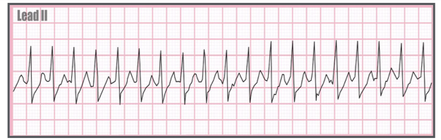 <p>Identify the above waveform:</p><p>a. SVT or atrial tachycardia</p><p>b. VTACH</p><p>c. PAC</p><p>d. AFIB</p>