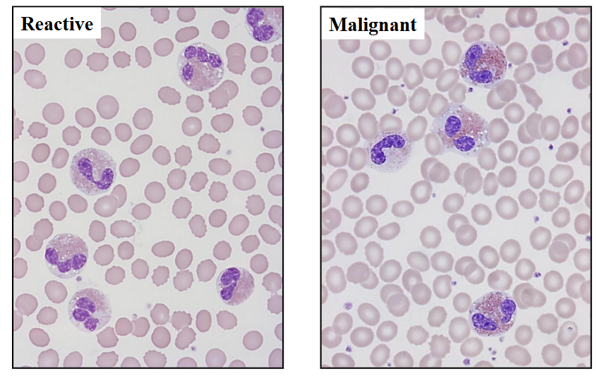 <p>Reactive vs Malignant shown</p><p>.</p><p>- on the left, some eosinophils dont look normal. with treatment they disappear rapidly</p><p>- on the right its dificult to differentiate between reacctive and malignant but the way to tell is bald spots present in cytoplasm (some spots devoid of granules).</p>