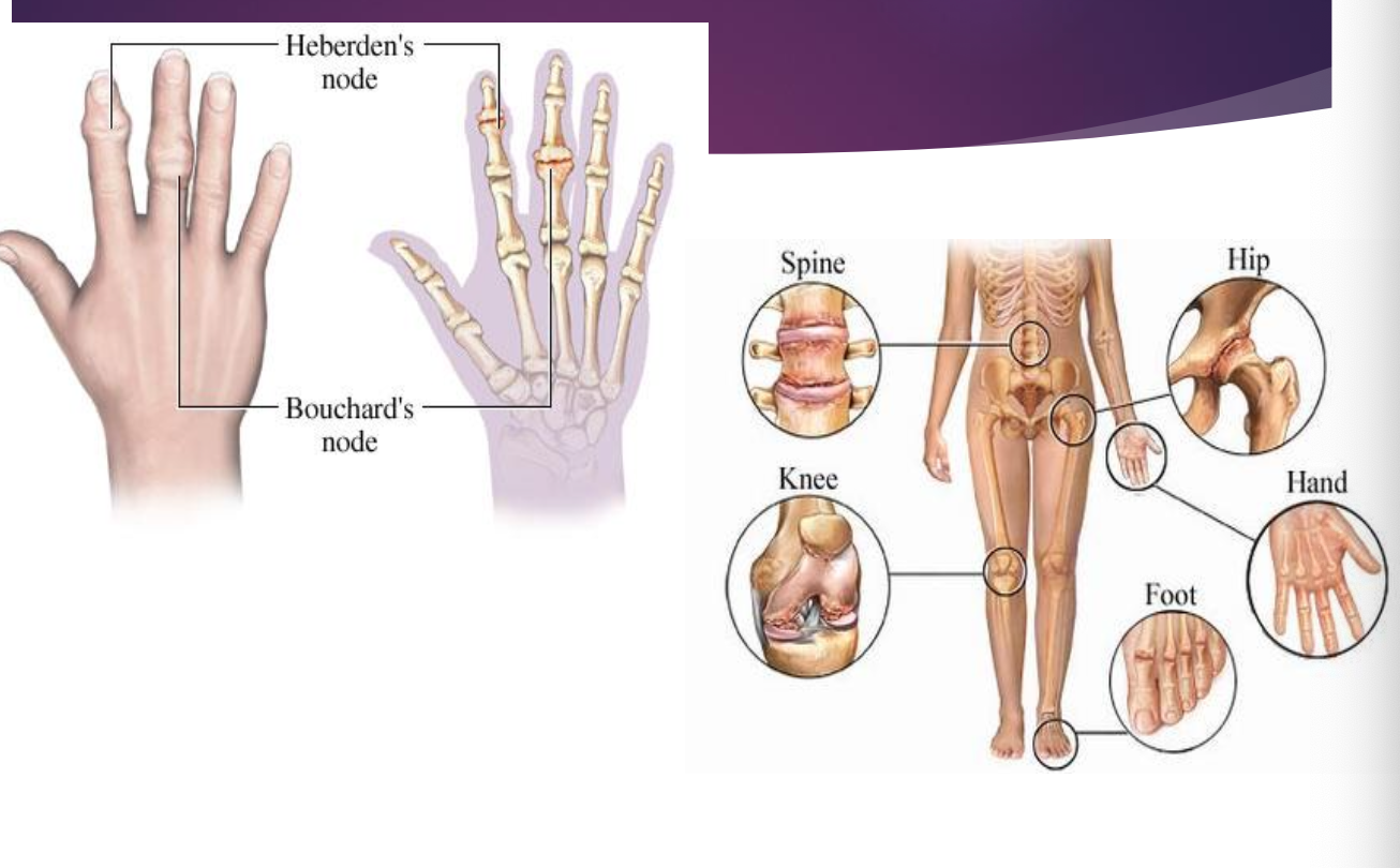 <p> Specific to joint involved</p><p class="p2"> Heberden’s nodes: DIP</p><p class="p2"> Bouchard’s nodes: PIP</p><ul><li><p class="p3"> Appear red, swollen, and tender</p></li></ul><p class="p2"> Varus deformity (bowlegged): medial knee</p><p class="p2"> Valgus deformity (knock-kneed): lateral knee</p><p class="p2"> One leg shorter than the other: hip</p>
