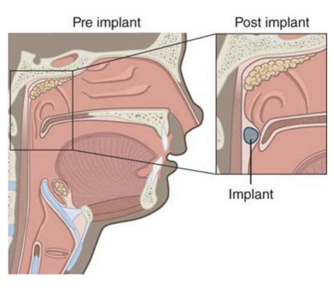 <p>Surgical procedure in which substances such as Teflon, silicone, dacron wool/silicone gel bag and cartilage may be implanted or injected into the PPW to make it bulge and thus close the VP port.</p>