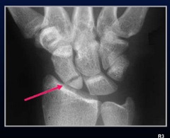 <p>Most common fracture occurs when person fall onto outstretched UE</p>