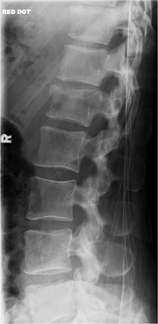 <p>Is this fracture old or new?</p>