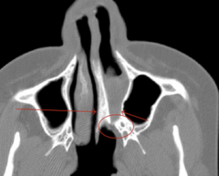 <p>-congenital problem in the neonatal period, relatively rare</p><p>-obstruction off nasal passages----> Cyanosis that WORSENS with feeding and IMPROVES with crying</p>