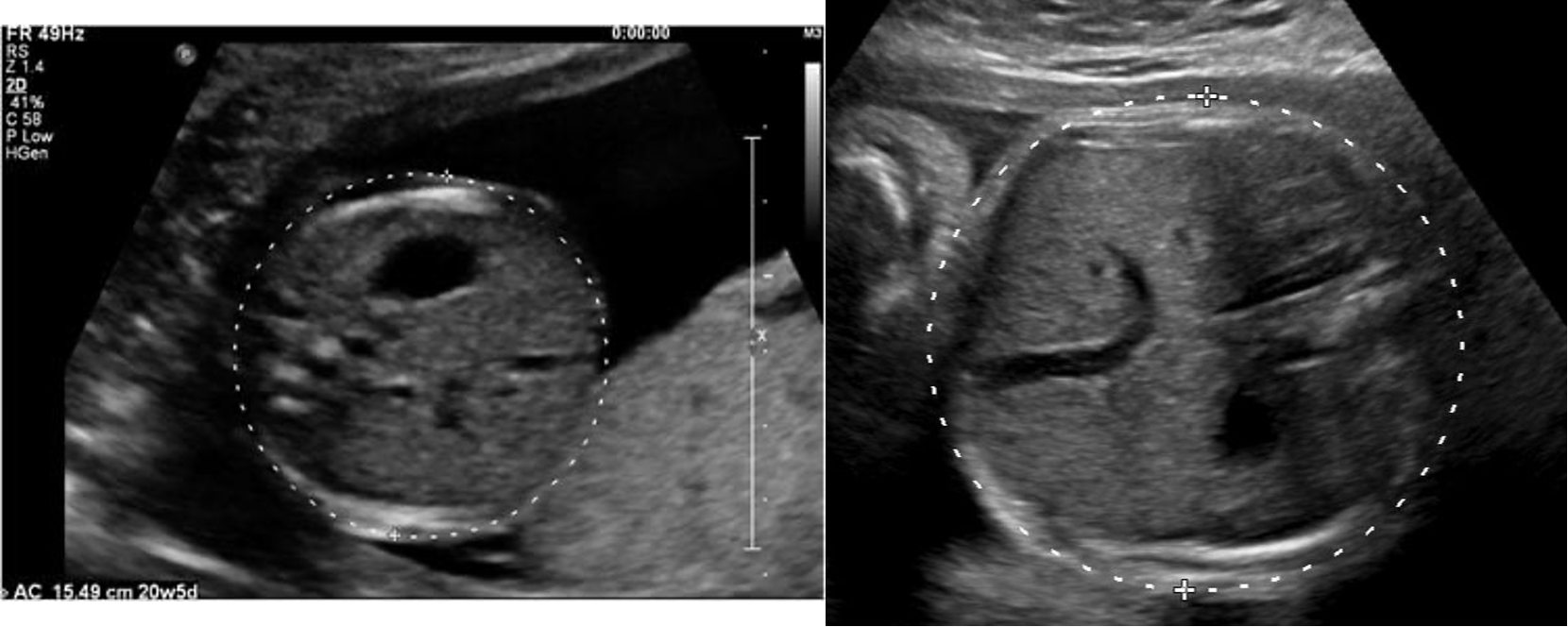 <p>abdominal circumference (AC)</p>