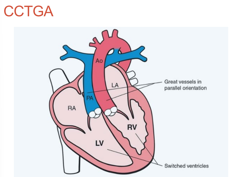 <p>Two wrongs make a right! •</p><p> Left atrium -> RV->aorta •</p><p> Essential to identify morphologically correct chambers! </p><p>• Identify moderator band! Look branch Pas! • </p><p>Aorta is located anterior and to the left of the pulmonary artery</p>