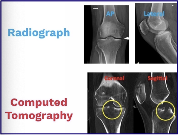 <ul><li><p>A radiograph sees the whole body region (BOOK)</p></li><li><p>A tomograph shows individual slices (INDIVIDUAL PAGES)</p></li></ul><div data-type="horizontalRule"><hr></div><p>Ex in photo: fx deep in the tibial plateau is easier seen on a CT scan</p><p></p>
