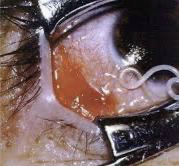 <ul><li><p>filarial roundworm </p></li><li><p>causes loiasis</p></li></ul><p></p>