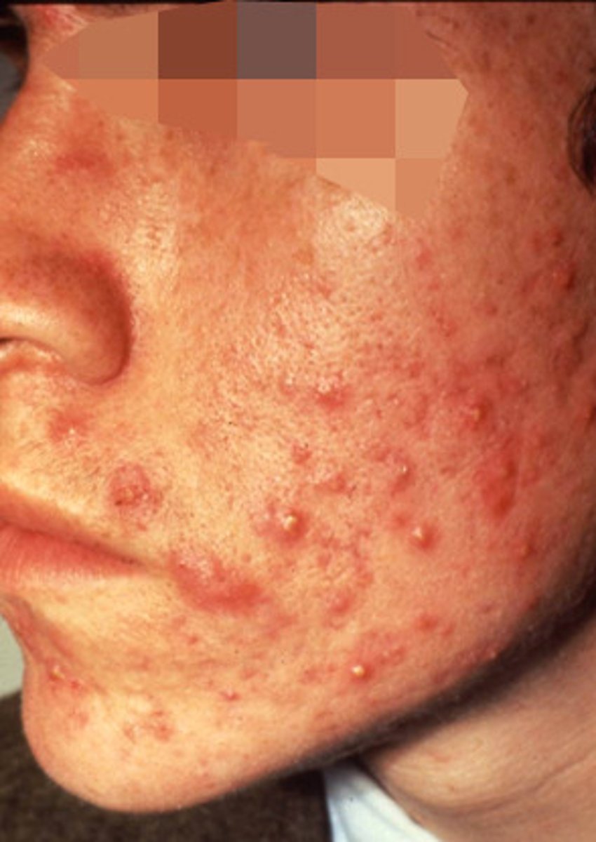 <p>inflammatory condition of sebaceous glands and hair follicles</p>