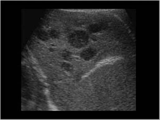 <p>diffuse or parenchymal change </p><p>hypo masses with target sign</p>