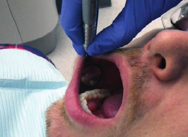 <ul><li><p>1 to 2 o’ clock</p></li><li><p>Rest finger on right side of patient’s face</p></li><li><p>Use mirror to retract buccal mucosa down and away from teeth</p></li><li><p>View distal, facial, and mesial surfaces in the mirror’s reflecting surface </p></li></ul><p></p>