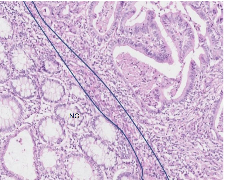 <p>The adenocarcinoma has not breached the muscularis mucosae</p>