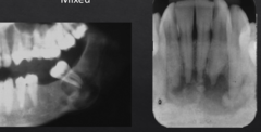<p>How is this lesion described in terms of density?</p>