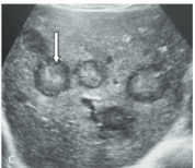 <p>Lung metastases</p>