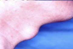 <ol start="92"><li><p>Identify the finding shown.</p></li></ol><p></p>