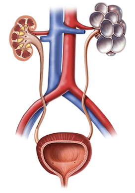 <ul><li><p>characterized by:</p><ul><li><p>cystic lesions that correspond primarily to dilated collecting tubules</p></li><li><p>cysts replace renal tissue (kidney doesn’t function)</p></li><li><p>cysts are nonfunctioning and noncommunicating</p></li></ul></li><li><p>usually unilateral; can be bilateral</p></li><li><p><span style="color: red;">MC form of renal cystic disease in childhood</span></p></li><li><p>associated with Meckel-Gruber; CNS, GI, cardiac, and limb anomalies</p></li><li><p>prognosis</p><ul><li><p>unilateral=excellent</p></li><li><p>bilateral=lethal</p></li></ul></li></ul><p></p>